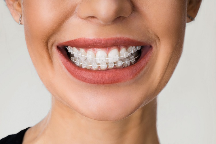 Behel Ceramic Nine Dental